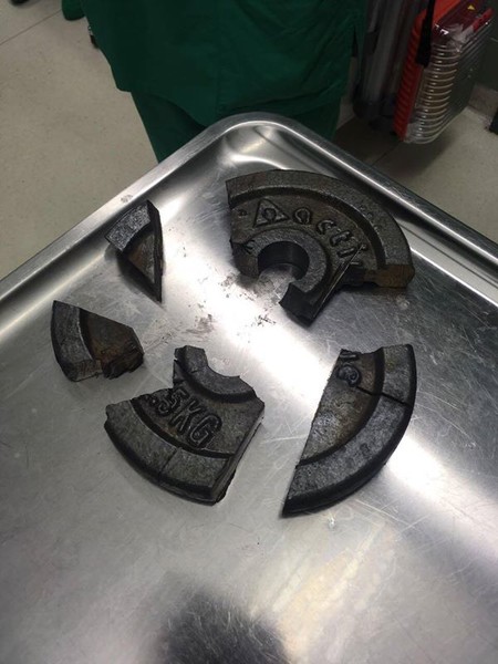 男性器がバーベルプレートの穴から抜けなくなり、消防隊が３時間かけて外す：コメント1