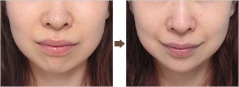 しゃくれあご整形で治した人・治したい人：コメント55