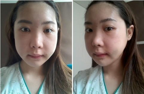 しゃくれあご整形で治した人・治したい人：コメント54