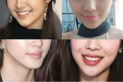 顎プロテーゼ入れてる人集まれ：コメント1