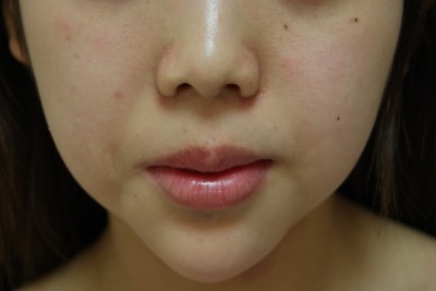 顎プロテーゼ入れてる人集まれ：コメント4