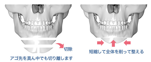 しゃくれあご整形で治した人・治したい人：コメント75