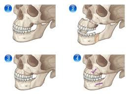 しゃくれあご整形で治した人・治したい人：コメント10