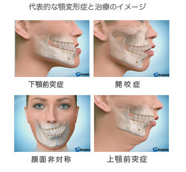 しゃくれあご整形で治した人・治したい人：コメント26