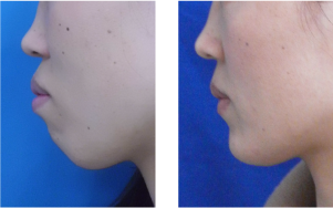 しゃくれあご整形で治した人・治したい人：コメント36