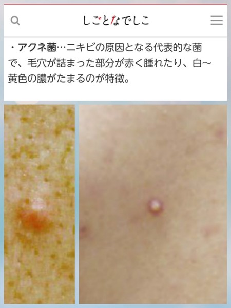 蛭子能収 背中にカビ「マセラチア菌」が繁殖 加齢臭原因に:コメント18