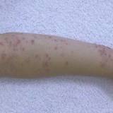 手足口病流行 東京都が警報発表 こまめに手洗いなど予防徹底を