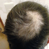 自ら髪を抜いた娘、気づけなかった母　3カ月は長かった