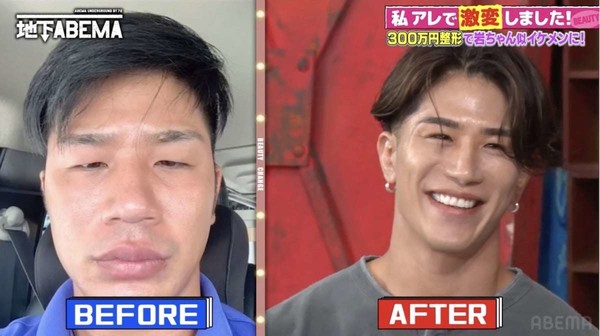 整形費用300万円で“岩田剛典似”に激変した男性登場 “やって良かった整形”告白：コメント2
